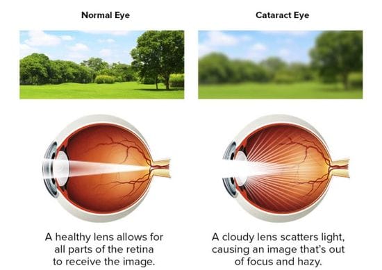 WHY SHOULD I LOOK OUT FOR CATARACTS?